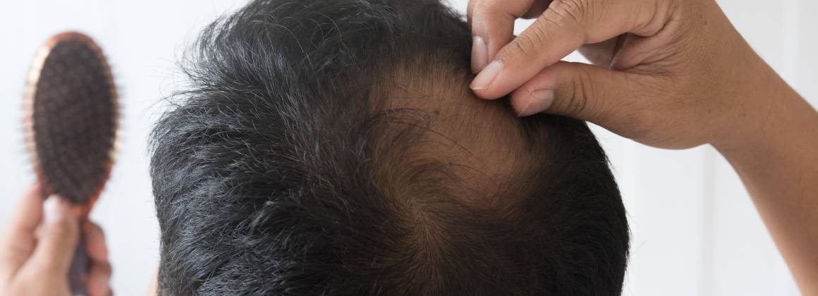 Repousser les cheveux clairsemés : Causes, symptômes et traitement de la chute et de la repousse des cheveux